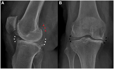 Case Report: Anterior Cruciate Ligament Calcification in a Patient With Chondrocalcinosis: Micro-Computed Tomography Presentation